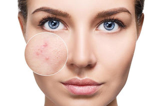 Common Causes of Adult Acne - Hey Honey Beauty