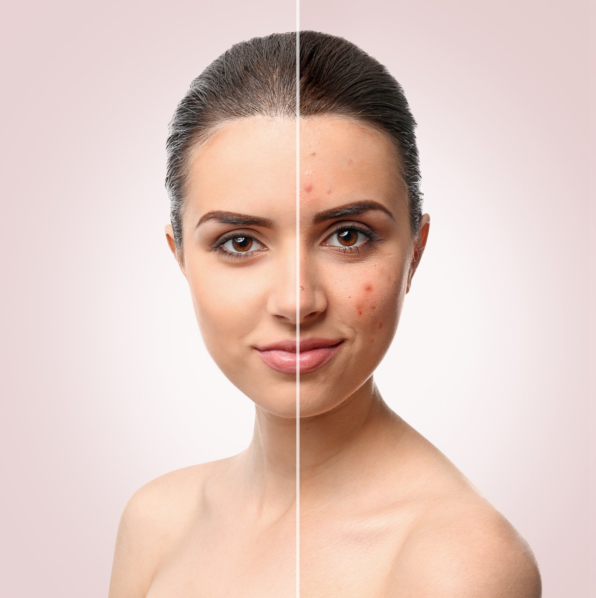 Propolis is Ideal for Use in Acne Treatments - Hey Honey Beauty