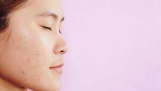 Skin Care for Oily Acne Prone Skin - Hey Honey Beauty