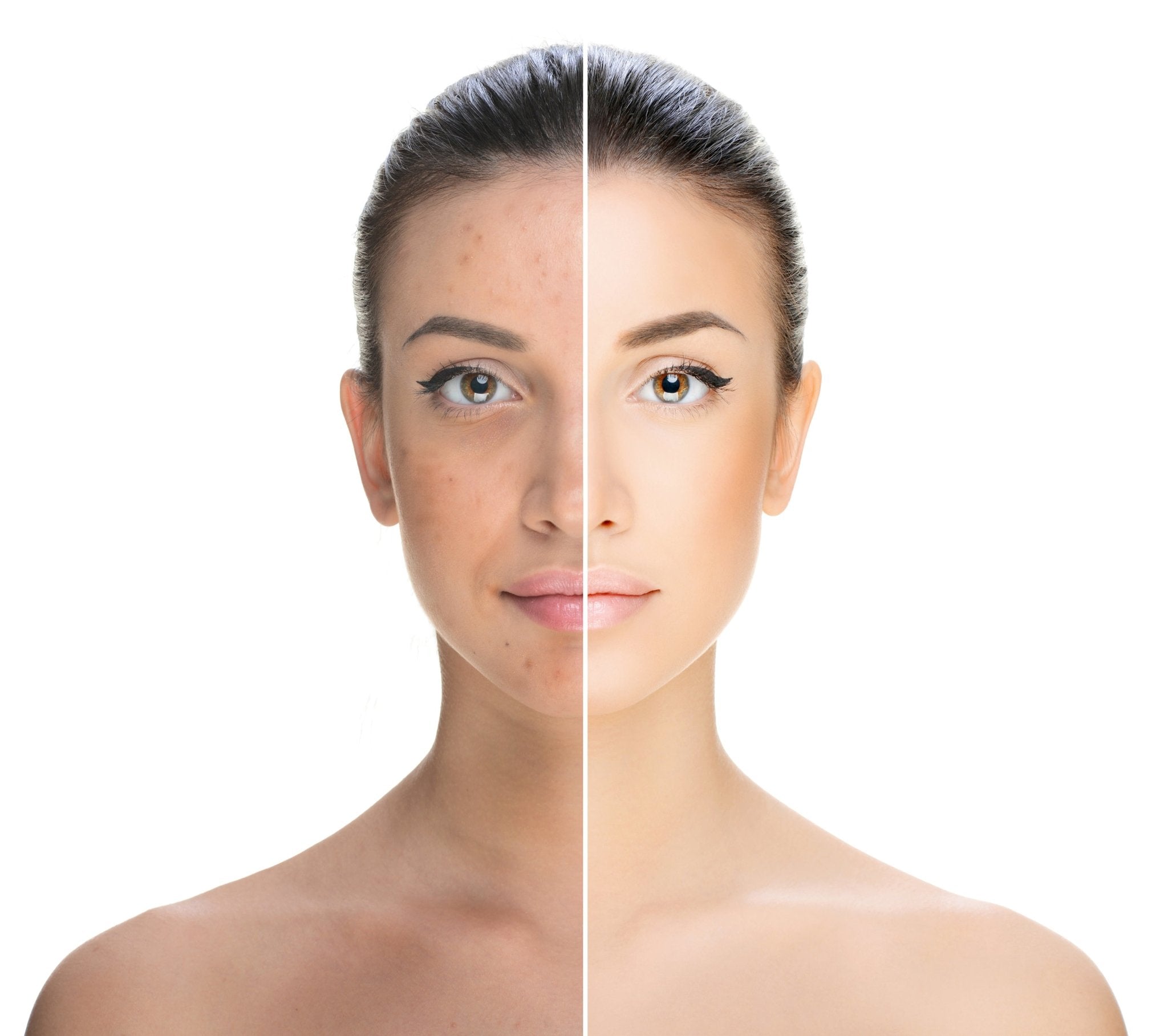 Unlocking Nature: Effective Solutions for Treating Acne - Hey Honey Beauty